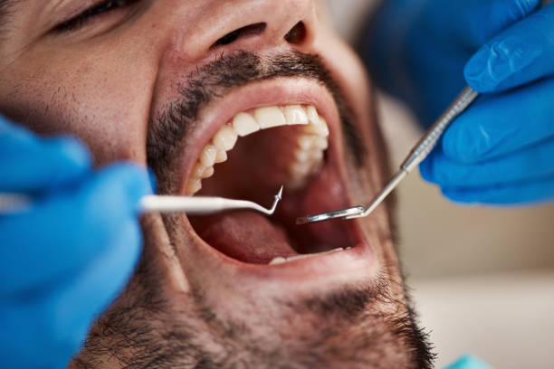 Best Dentist for Tooth Abscess  in Hughson, CA